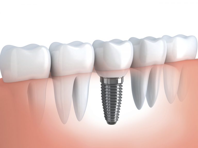 Interesujące fakty na temat implantów stomatologicznych